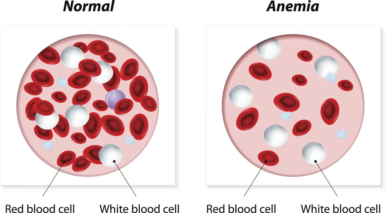 What is Anemia? Anemia symptoms, types and treatment methods