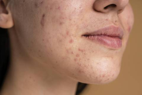 Why Do These 5 Skin Problems Worsen in Summer? Causes and Solutions